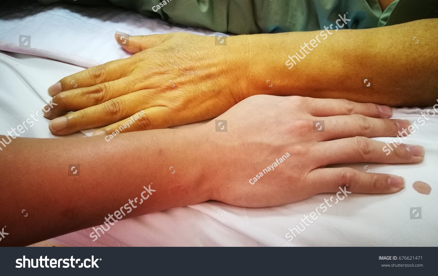 Yellow palms and other signs of jaundice Yellow palms and other signs of jaundice