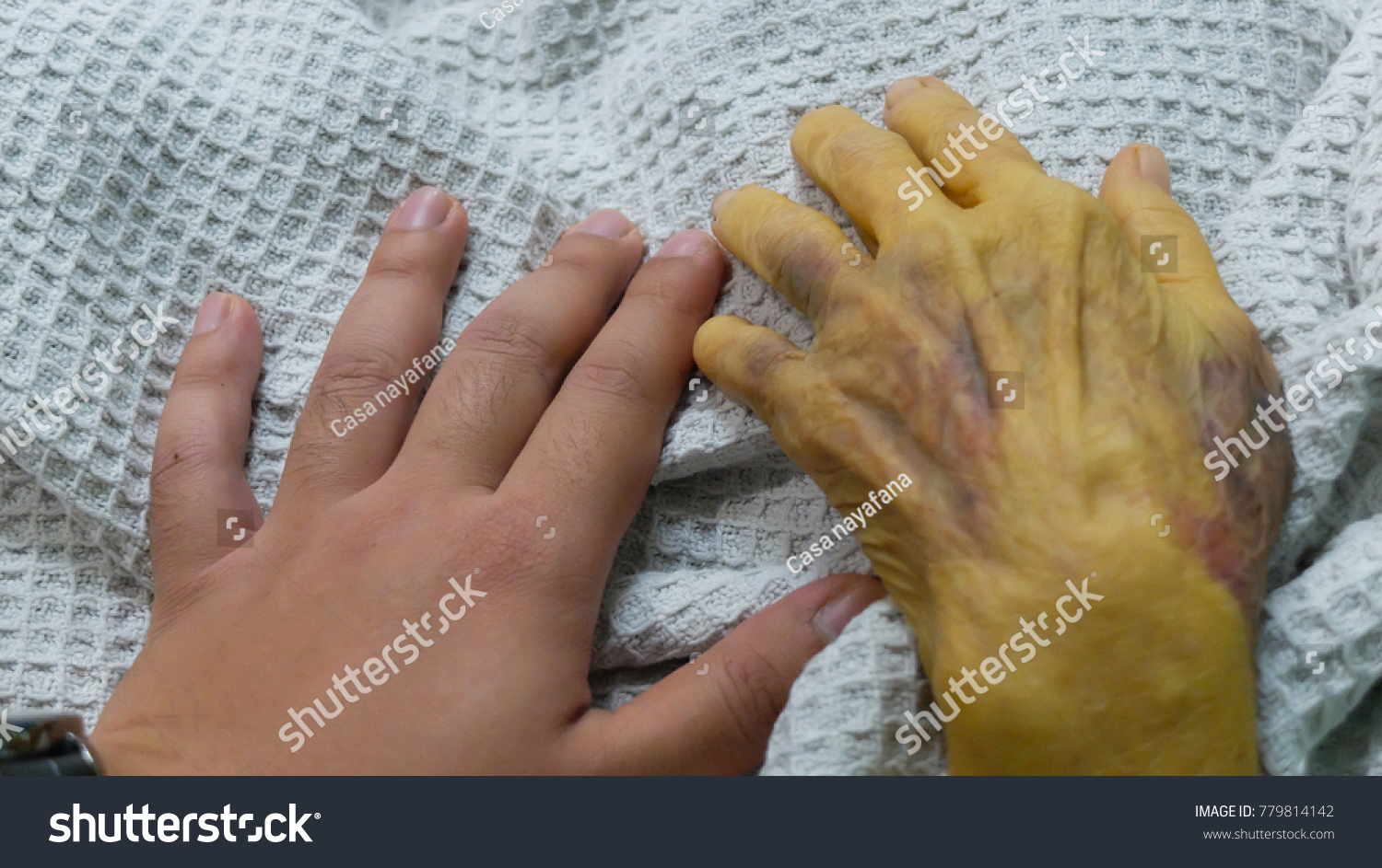 Yellow palms and other signs of jaundice Yellow palms and other signs of jaundice