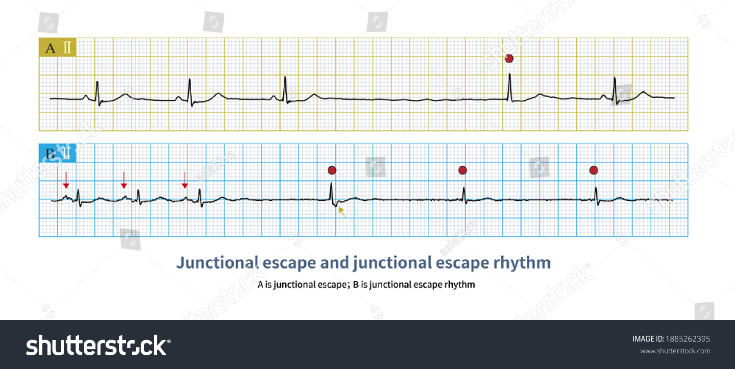 Junctional Escape Rhythm Defined Junctional Escape Stock Illustration ...