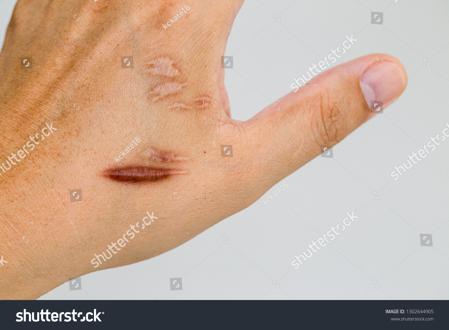 事故後の男性の手肌のケロイド瘢痕 ケロイド状の手首の皮膚の傷跡は 車の事故で手術を受けた場合に生じる 皮膚の損傷が治った部位にある一種の傷跡の形成である の写真素材 今すぐ編集 1302644905