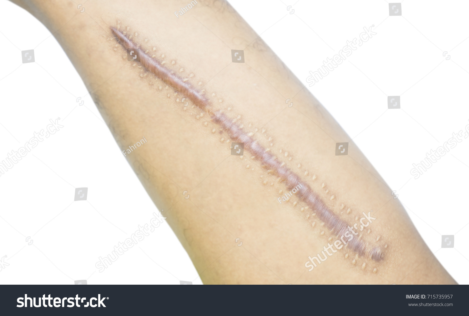 Keloid Scar On Leg Skin Hypertrophic Zdjęcie Stockowe Edytuj Teraz