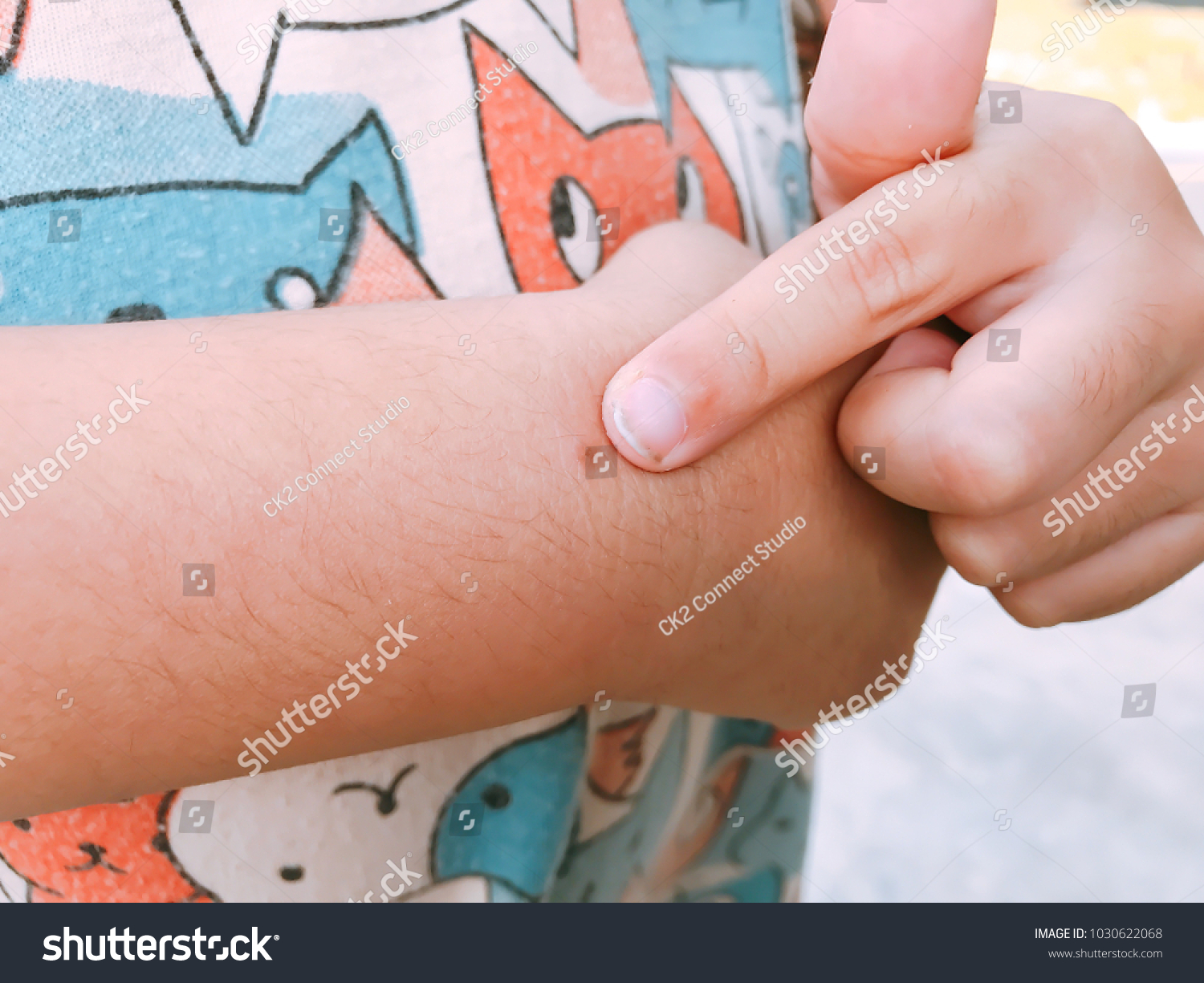 Kids Arm Bited By Mosquito Stock Photo Edit Now