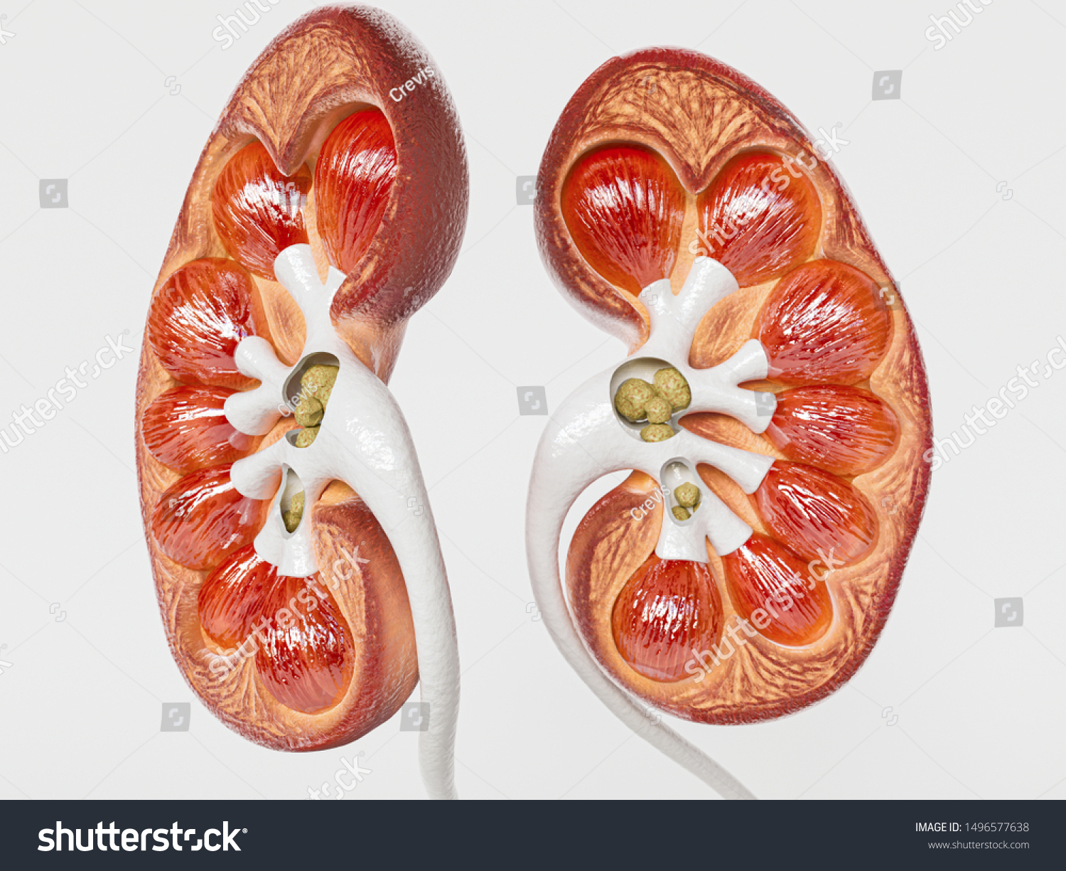Kidney Stones Cross Section Kidney 3d Stock Illustration 1496577638 ...