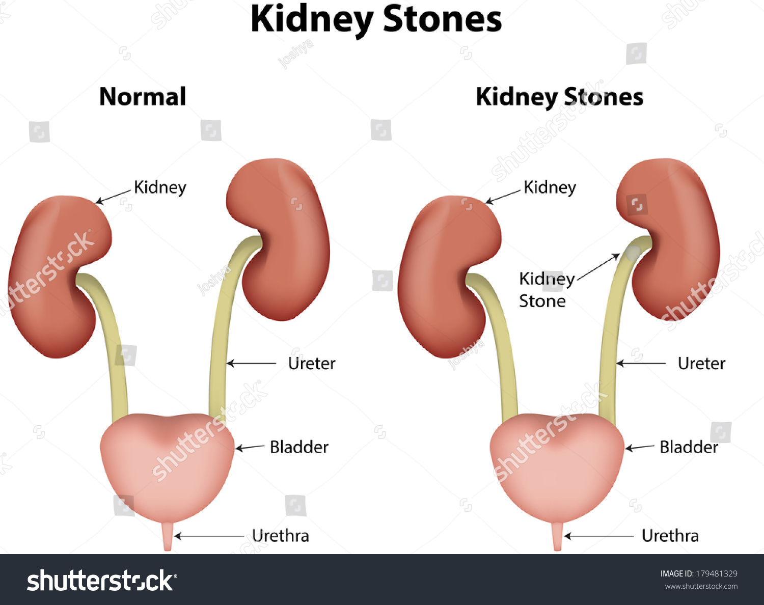 kidney-stones-in-the-urinary-system-stock-photo-179481329-shutterstock