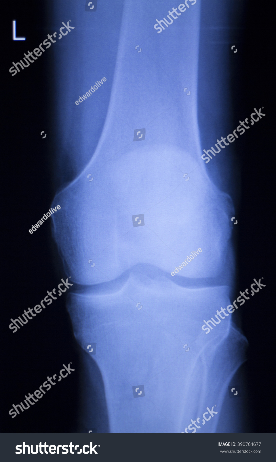 Knee Meniscus Injury Medical Xray Test Stock Photo 390764677 | Shutterstock