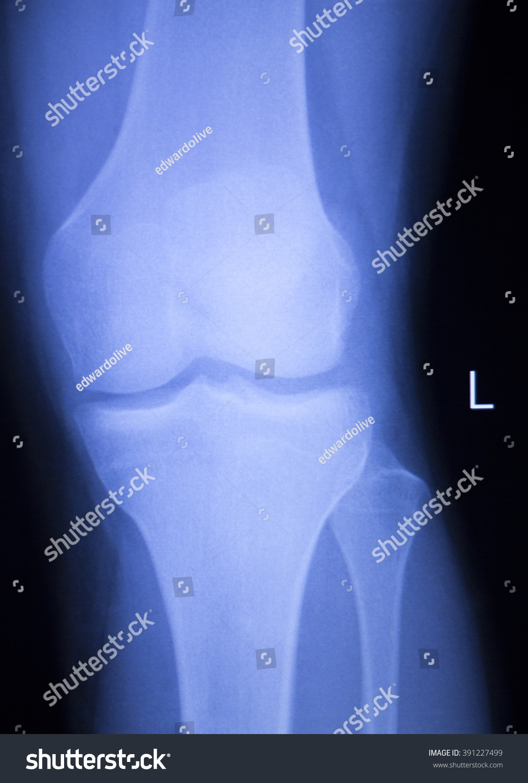 Knee Meniscus Injury Medical Xray Test Stock Photo (Edit Now) 391227499