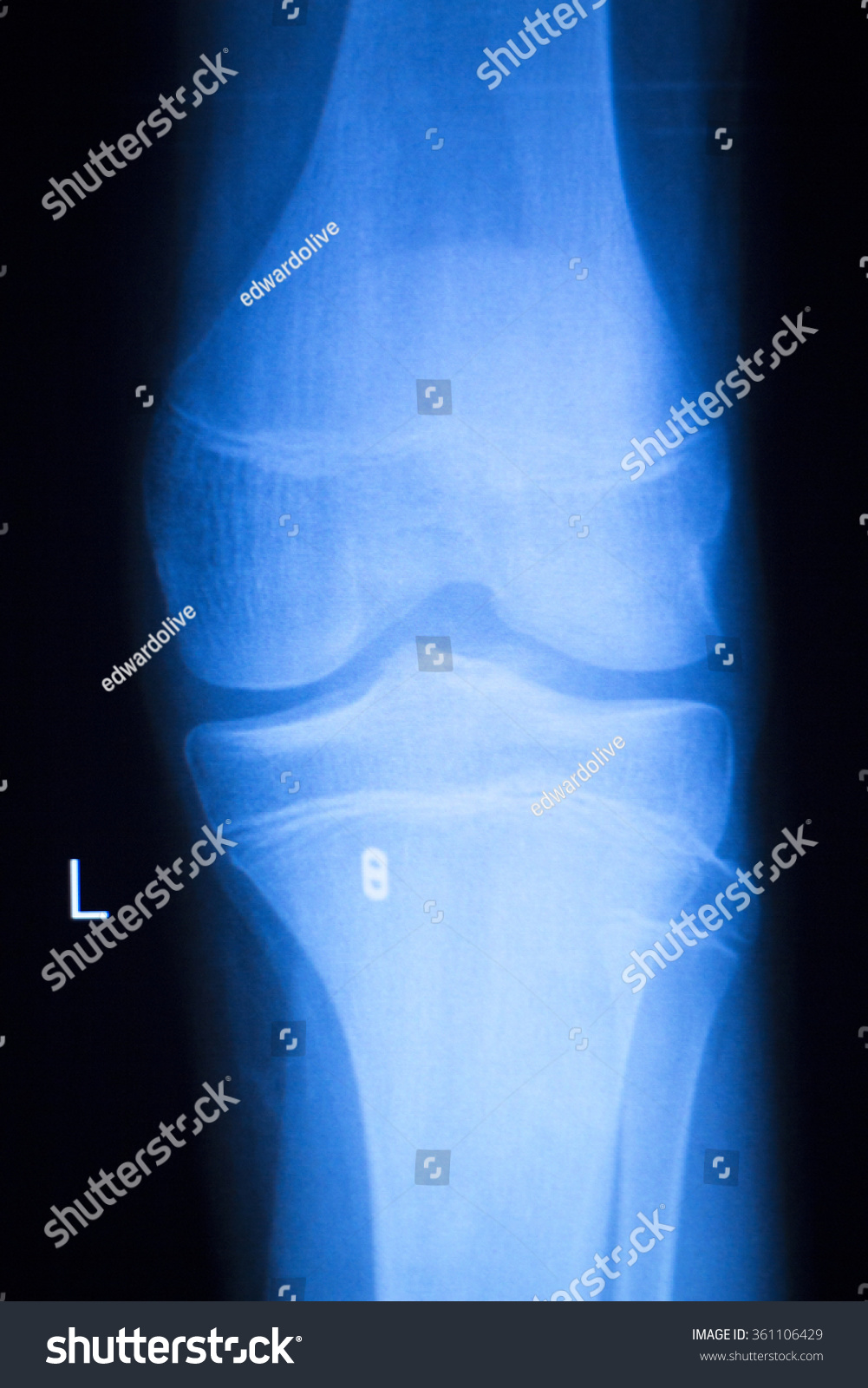 Knee Joint Meniscus Xray Test Scan Stock Photo 361106429 - Shutterstock