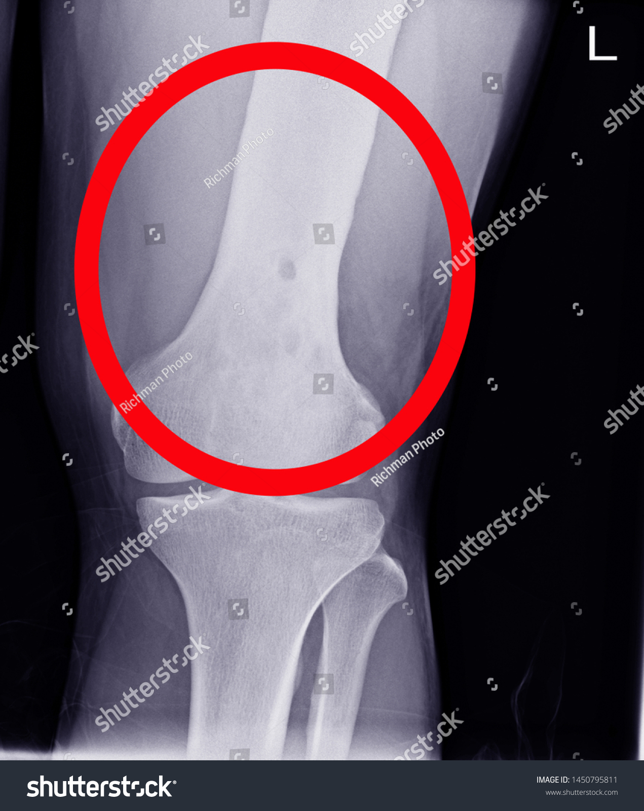 Knee Jointsmall Lytic Lesion Distal Femur Stok Fotoğrafı Şimdi Düzenle 1450795811