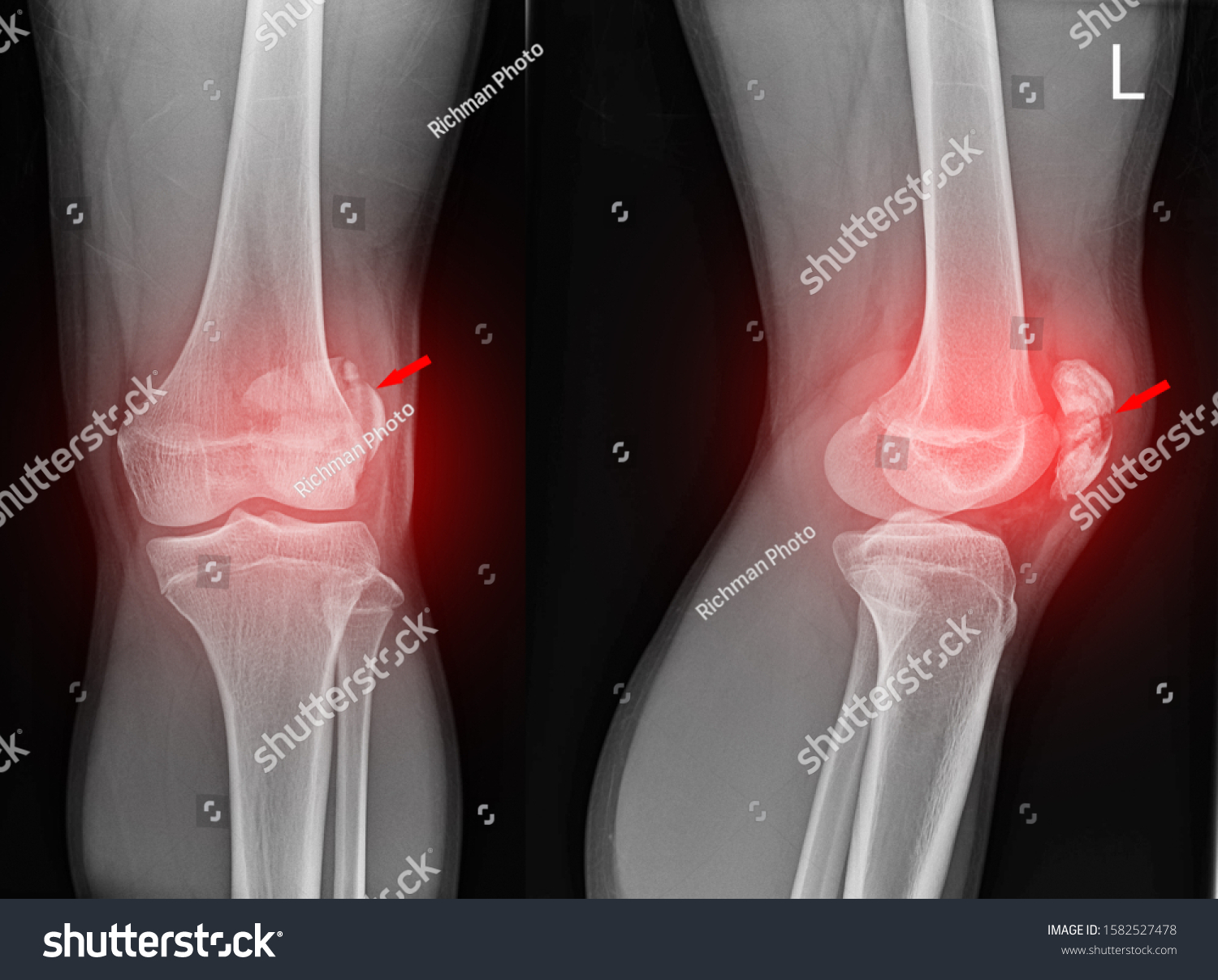 Knee Joint Xrayap Lateral View Fracture Stock Photo 1582527478 ...