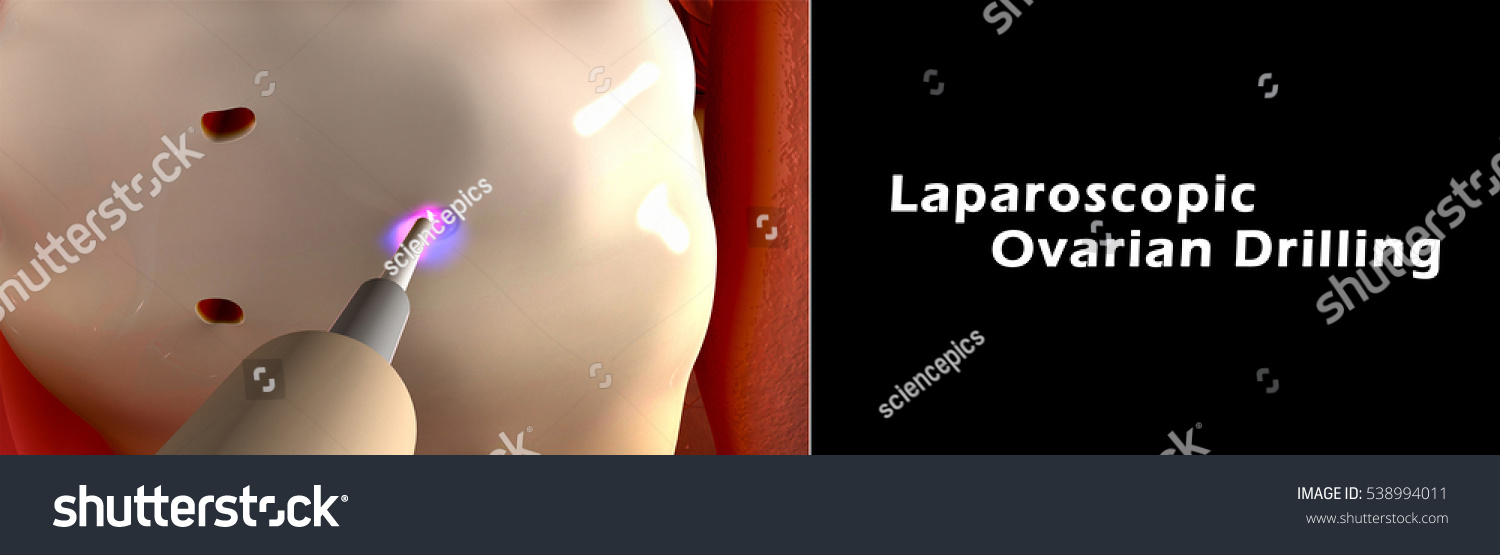 Laparoscopic Ovarian Drilling 3d Illustration Stock Illustration 538994011 Shutterstock 2179