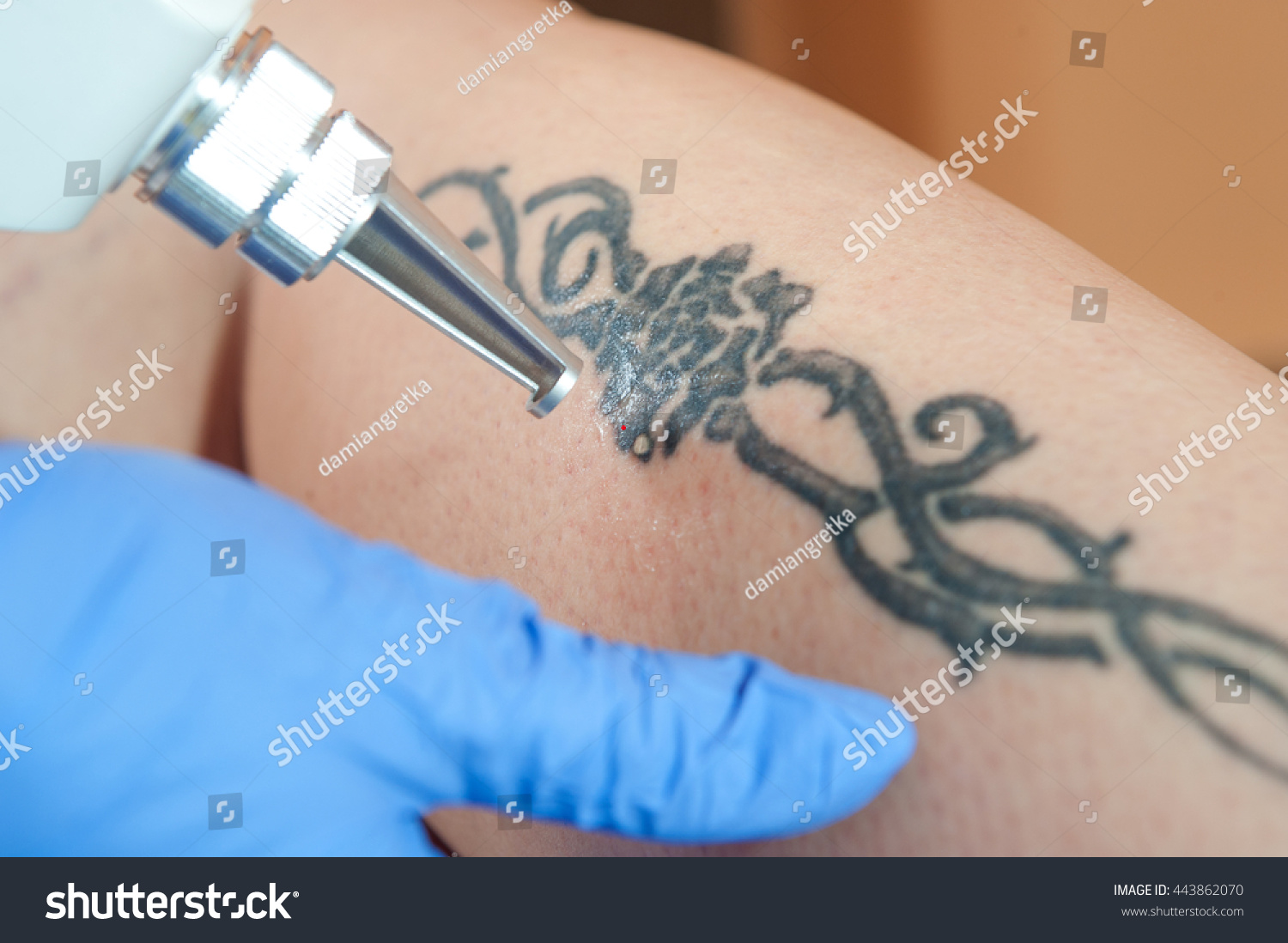 laser tattoo removal leg tattoo stock photo 443862070 laser tattoo removal leg tattoo stock photo 443862070