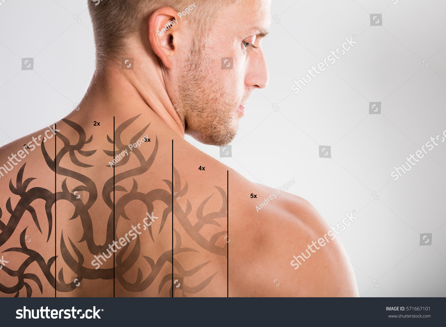laser tattoo removal on shirtless mans stock photo 571667101 laser tattoo removal on shirtless mans stock photo 571667101