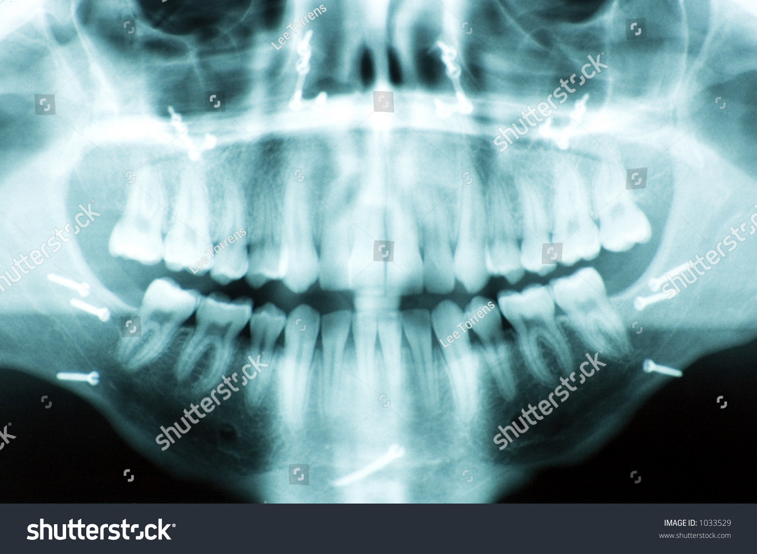 Lateral Ceph Jaw X-Ray Showing Screws Used To Reconstruct The Jaw Bones ...