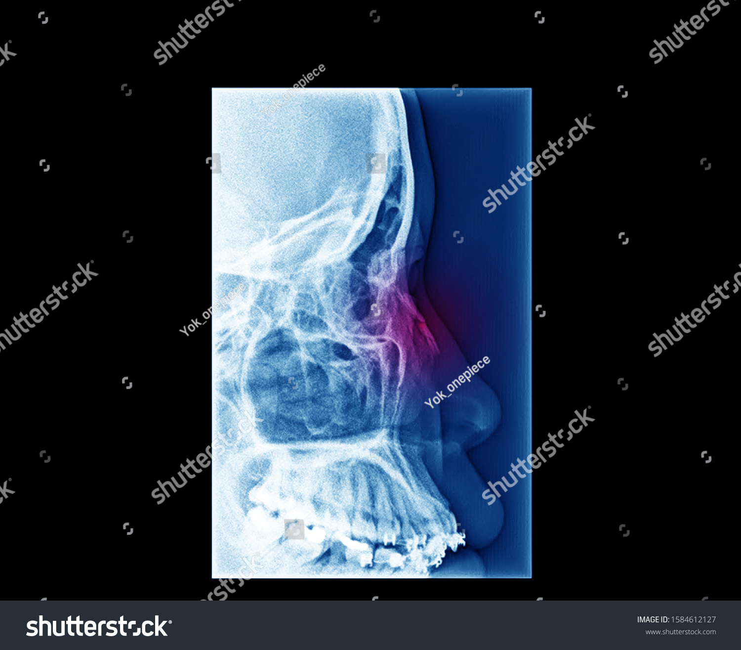 Lateral Nasal Bone Xray Showing Closed Stock Photo 1584612127 ...