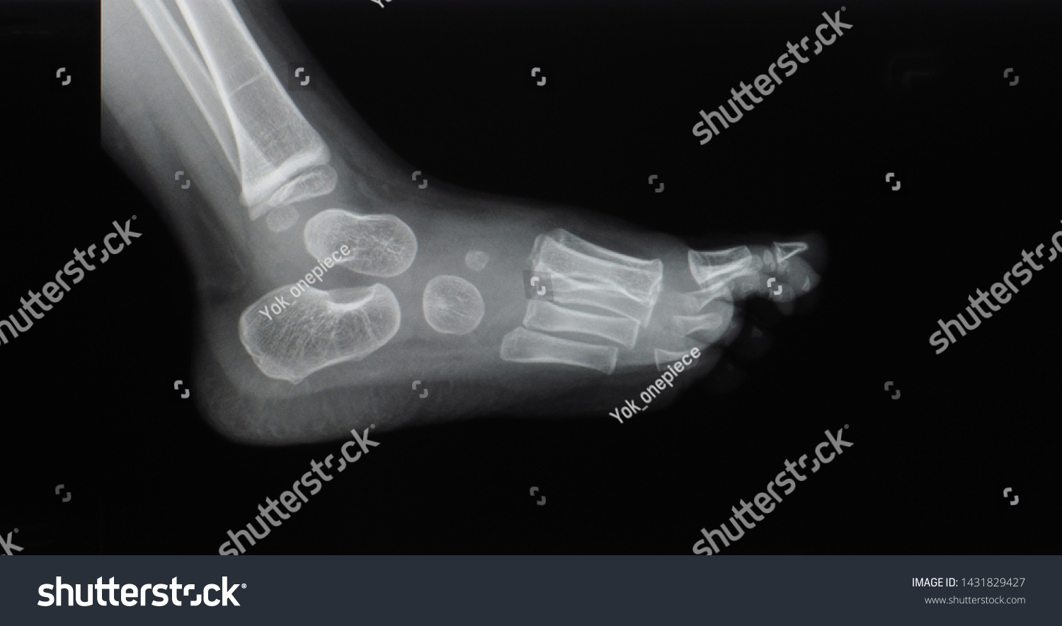 lateral-projection-xray-foot-ankle-child-1431829427