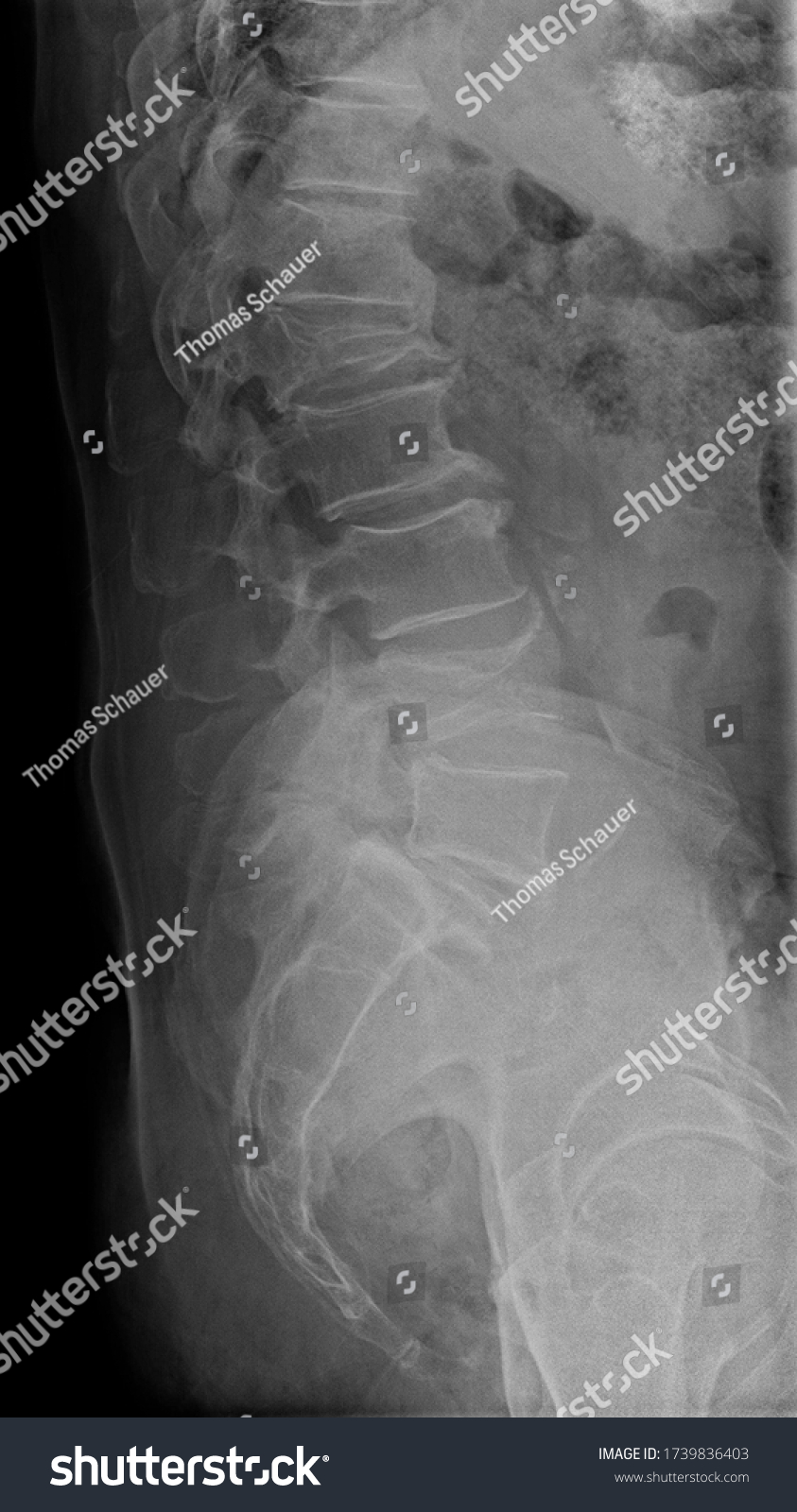 Lateral View Lumbar Spine Xray Showing Stock Photo (Edit Now) 1739836403