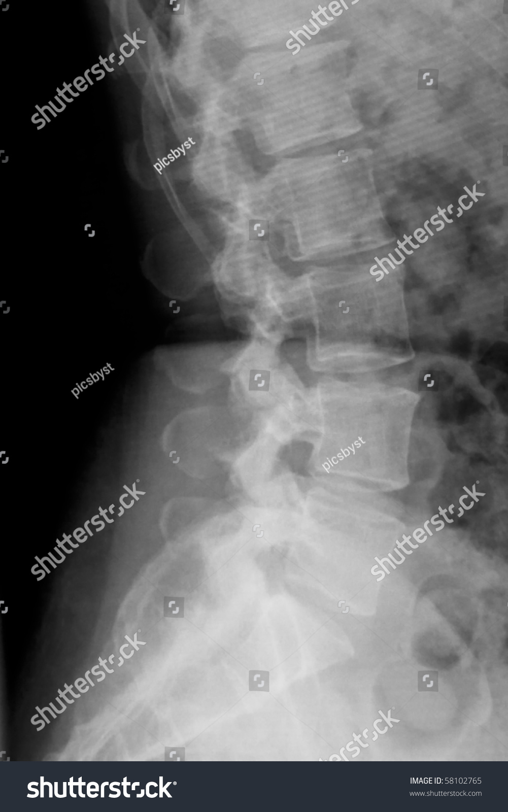 Lateral Xray Lower Back Stock Photo 58102765 - Shutterstock