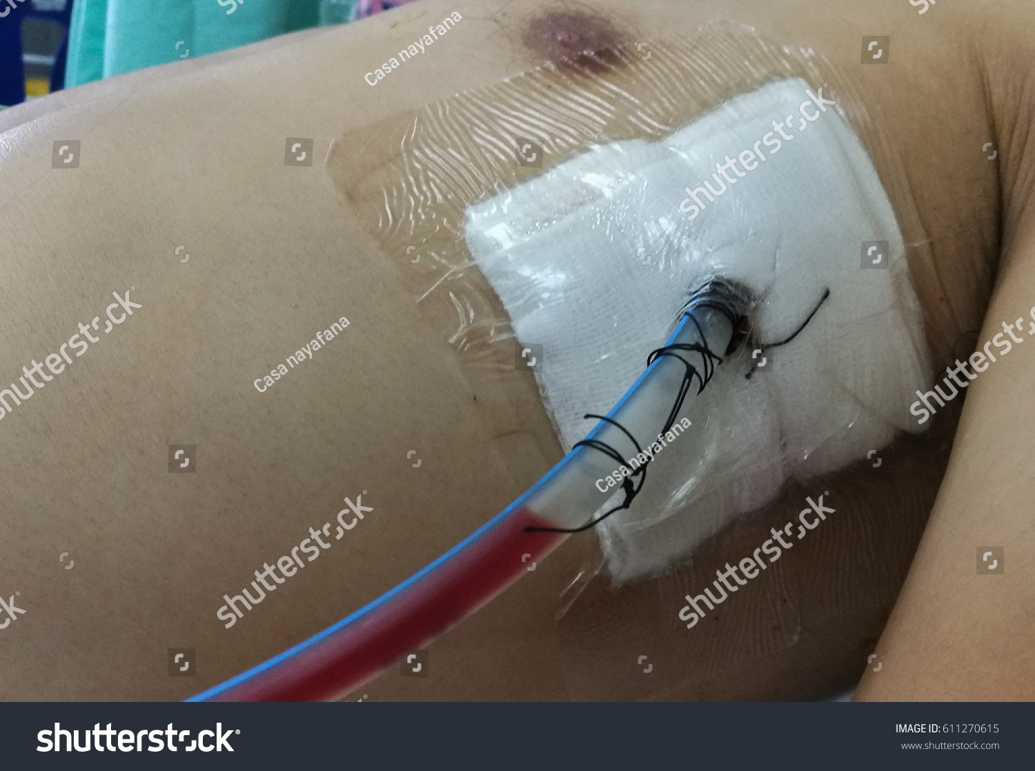 2,737 "chest tube" Images, Stock Photos & Vectors | Shutterstock