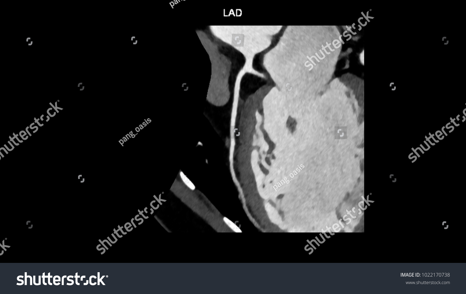 6 Anterior interventricular branch of left coronary artery Images ...