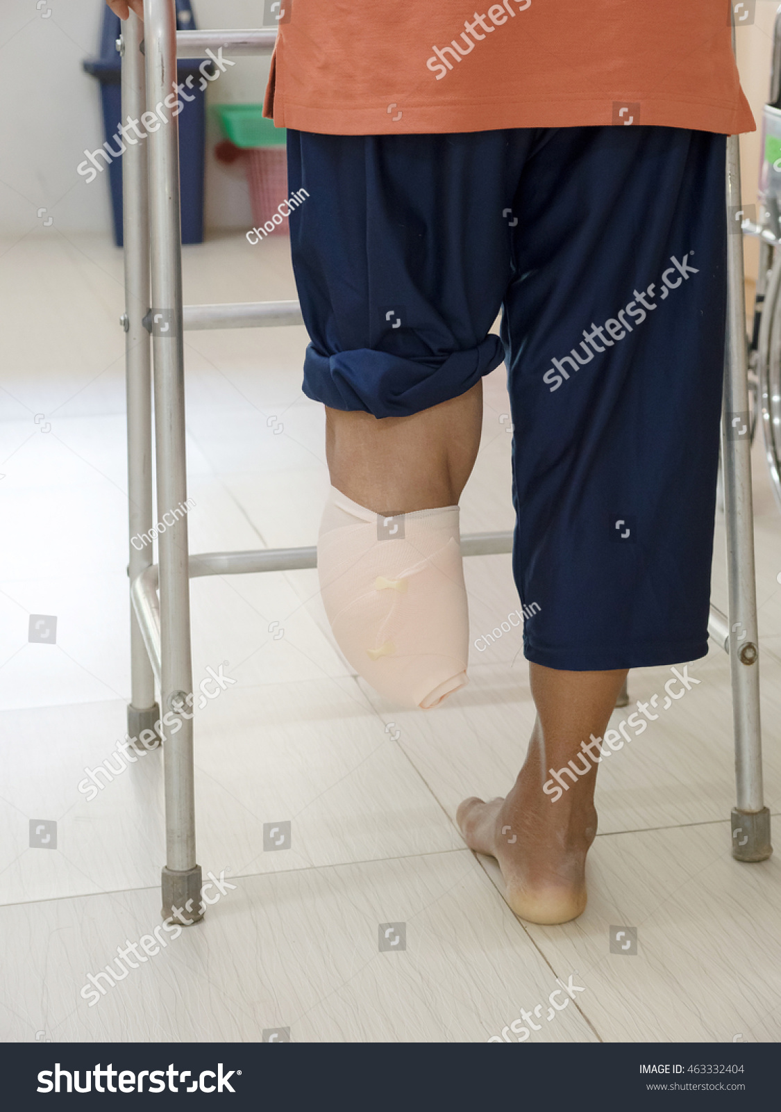 Left Leg Amputee Cause By Diabetic Stock Photo 463332404 | Shutterstock