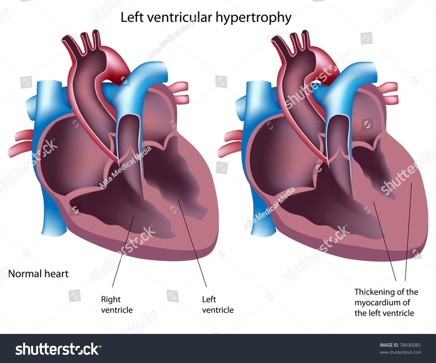 Left Ventricular Hypertrophy Stock Illustration 78690085 - Shutterstock