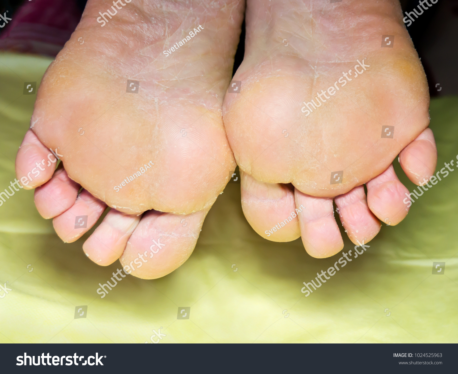dry cracked yellow feet