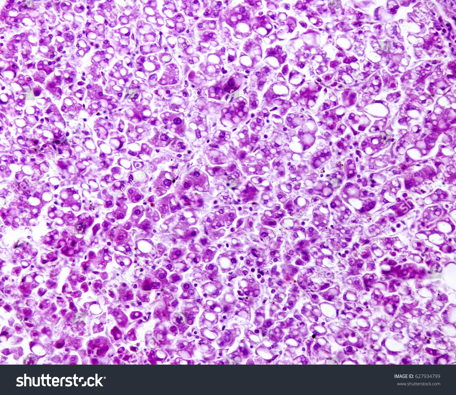 Liver Fat Degeneration Steatosis Diffuse When Stock Photo 627934799