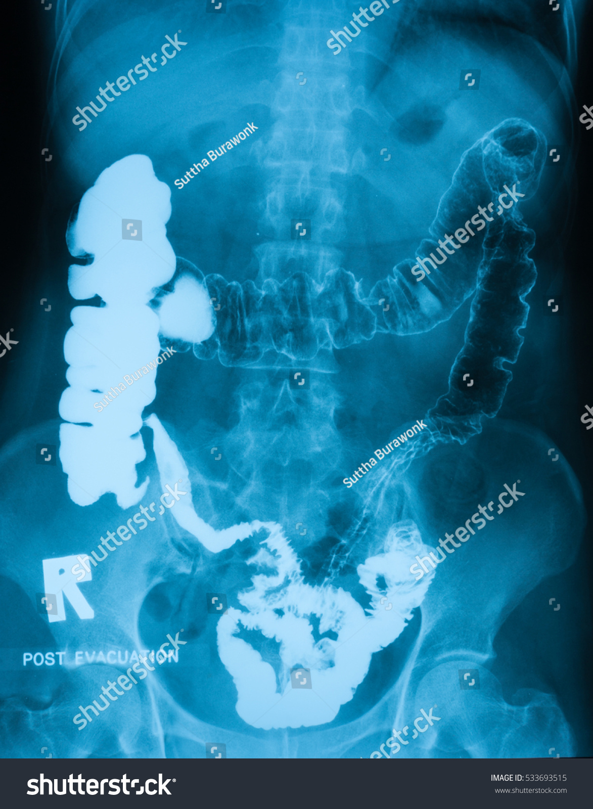 Lower Gastrointestinal Gi Tract Xray Radiography Foto De Stock 533693515 Shutterstock 0320