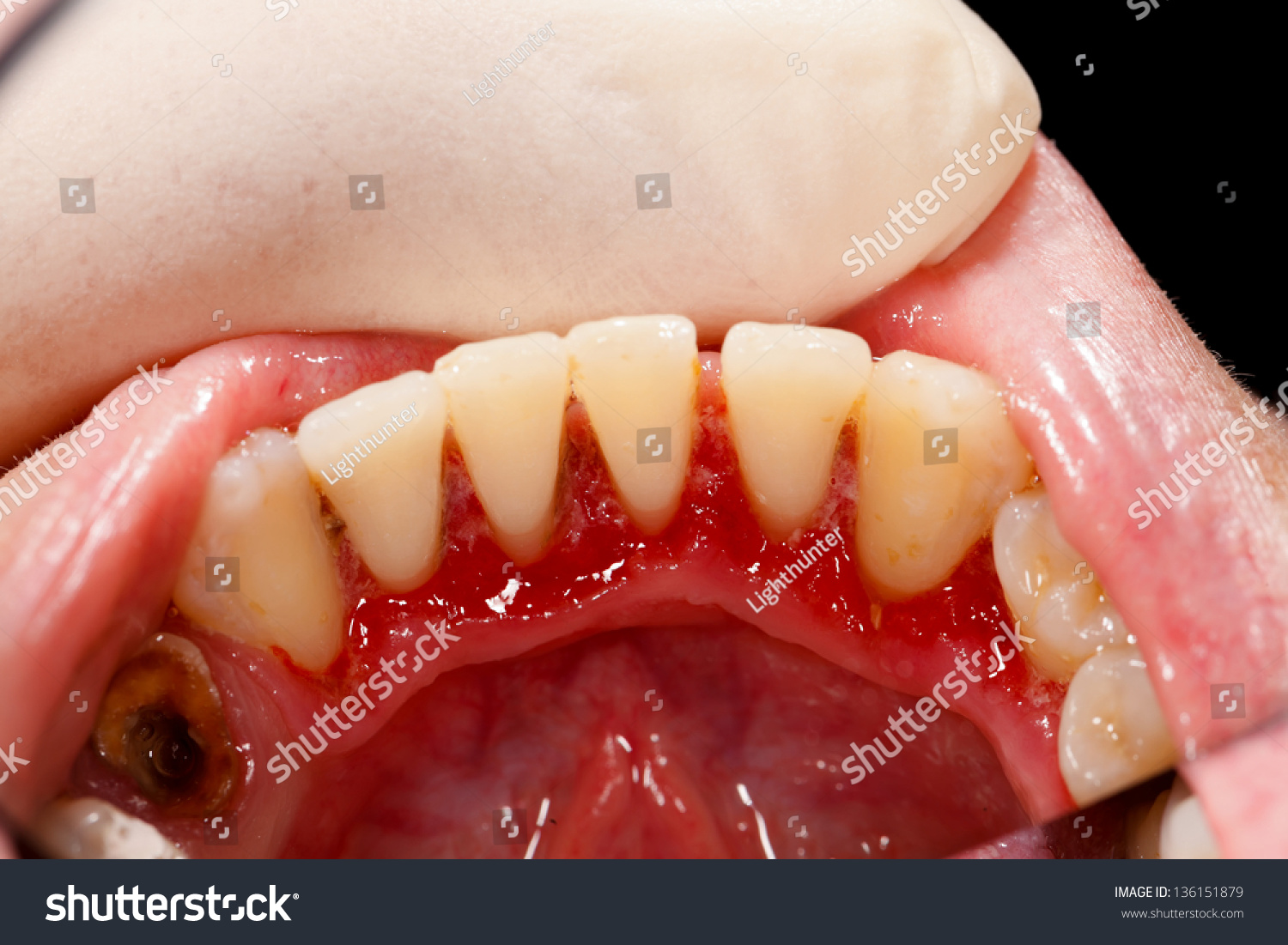 Lower Incisors After Periodontal Treatment Broken Stock Photo 136151879 ...