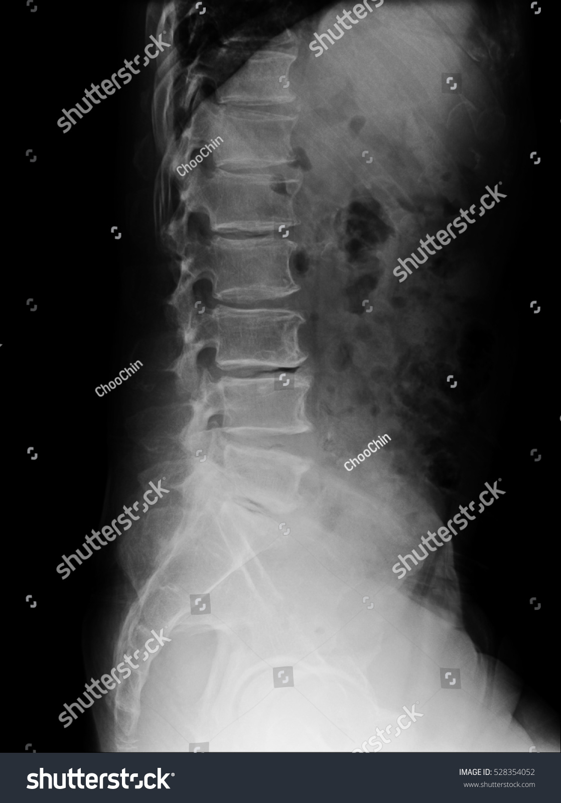 Lumbar Spine Of A Human Body On X-ray Side View. Stock Photo 528354052 