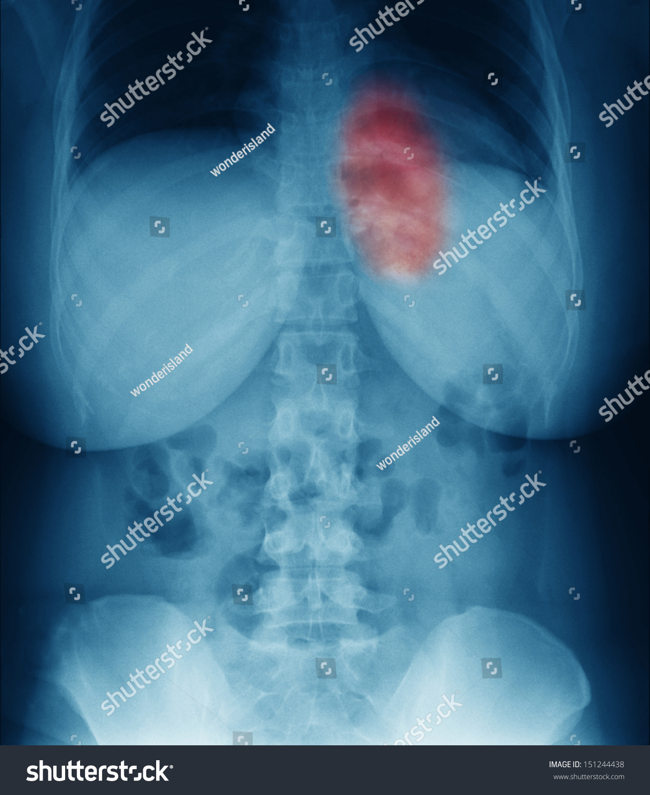 Lung Cancer In Women Stock Photo 151244438 Shutterstock