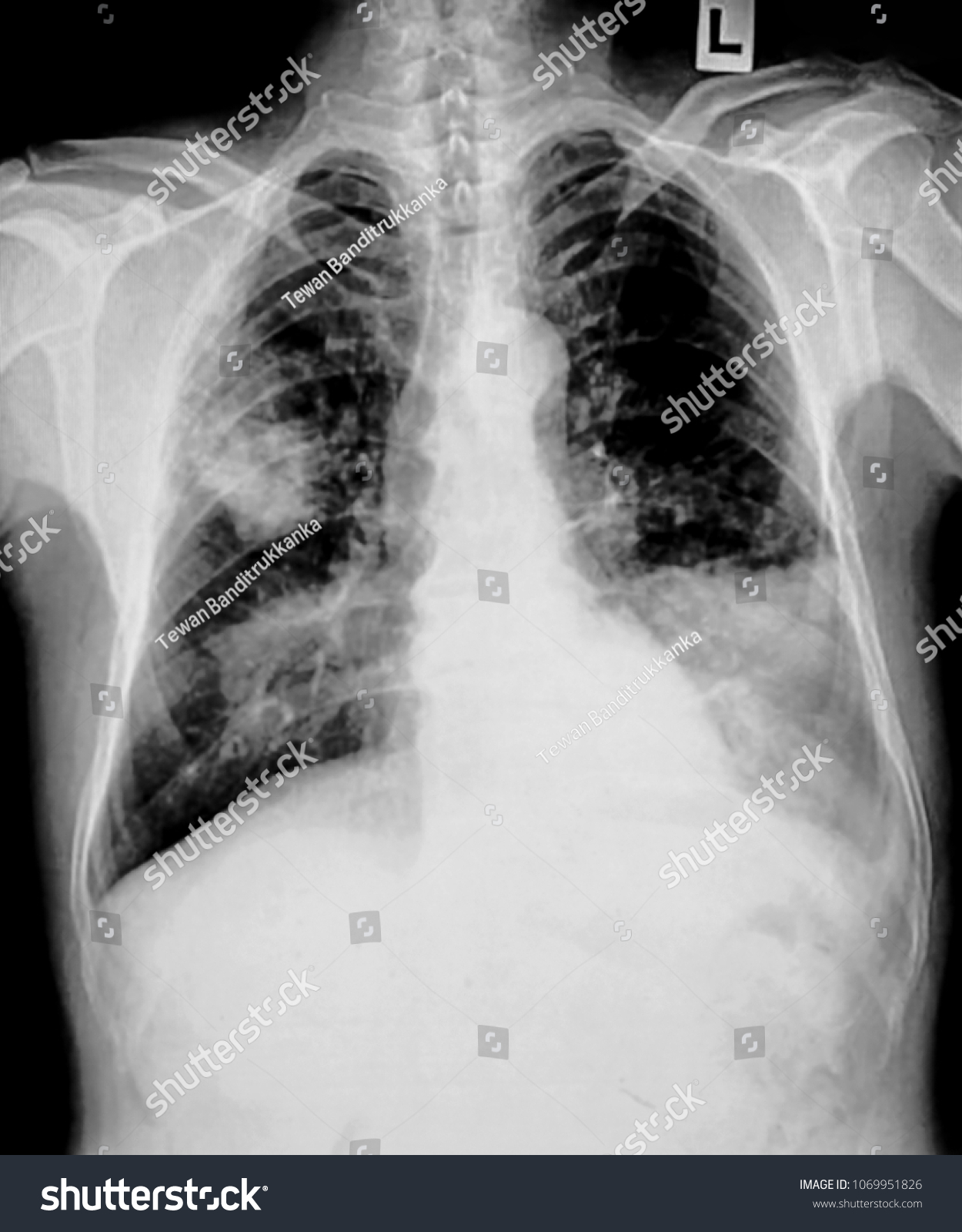 Lung Cancer Pleural Effusion Stock Photo 1069951826 | Shutterstock