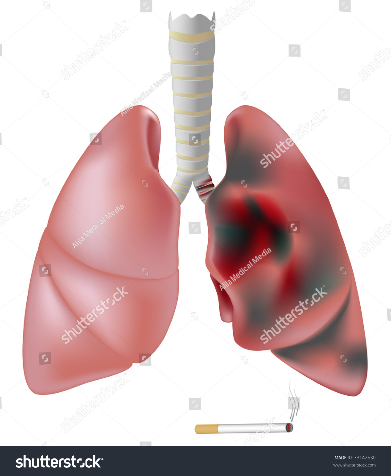 Lung Half Healthy Half Diseased With Cancer Stock Photo 73142530 ...