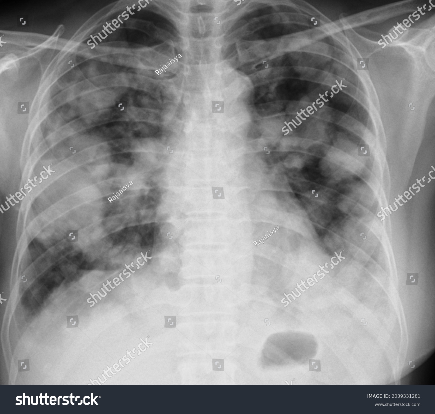 Lung Metastasis Process Chest X Ray Stock Photo (Edit Now) 2039331281