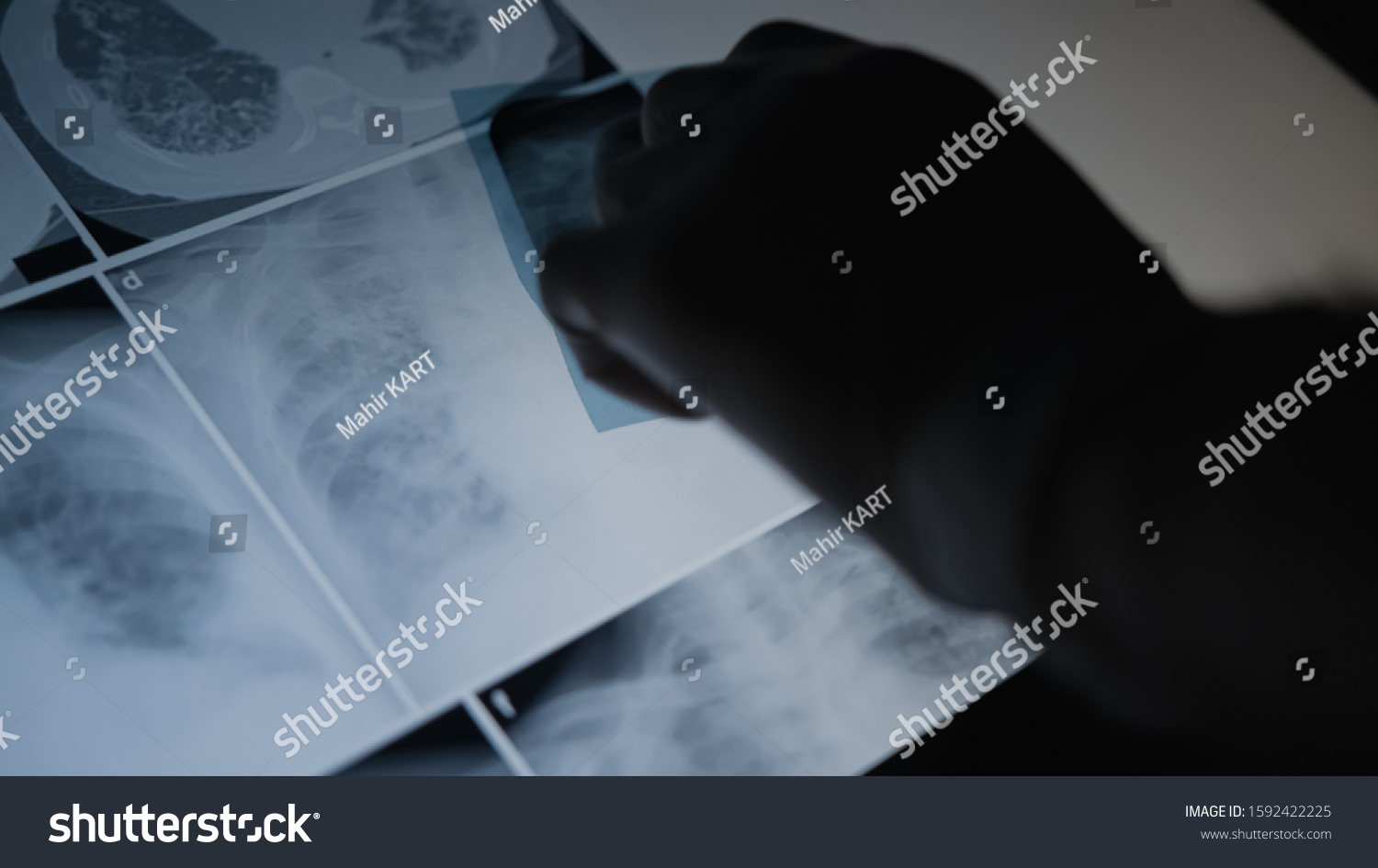 Lung Radiography Concept Radiology Doctor Examining Stock Photo (Edit ...