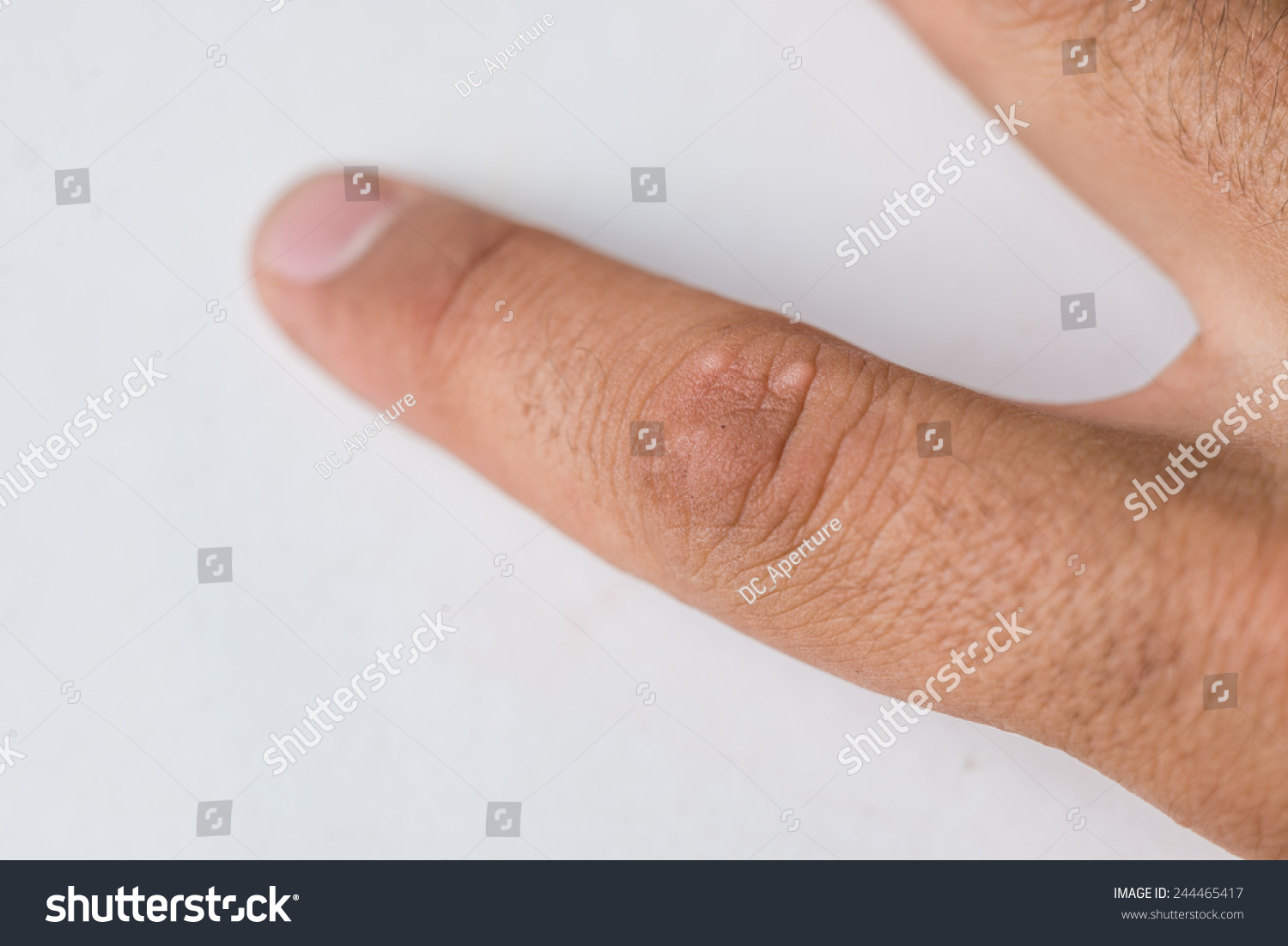 Macro Close Warts Finger White Background Stock Photo Edit Now