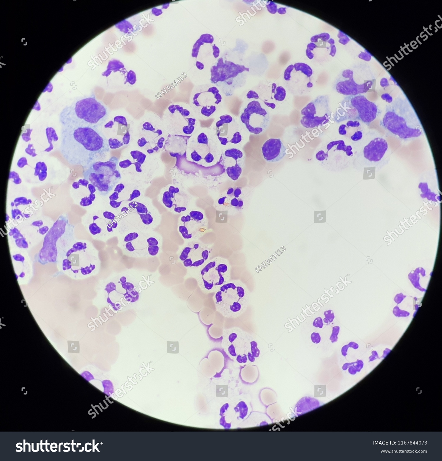 Macrophage Neutrophil Hematoidin Crystal Body Fluid Stock Photo ...