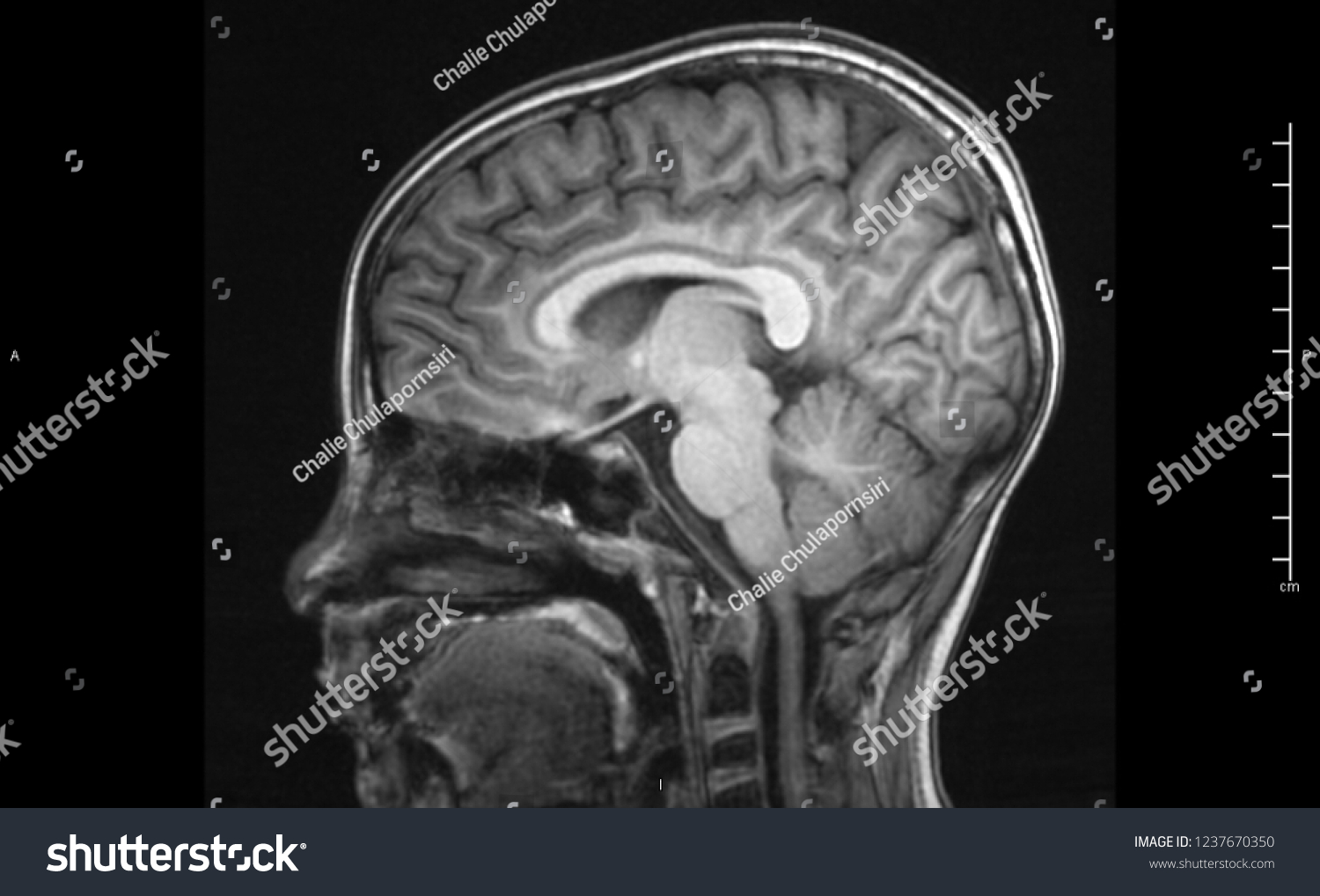 Magnetic Resonance Image Mri Brain Sagittal Stock Photo 1237670350 ...
