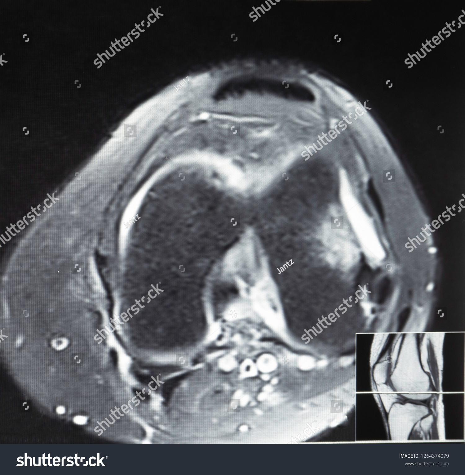 Magnetic Resonance Imaging Mri Image Knee Stock Photo 1264374079 ...