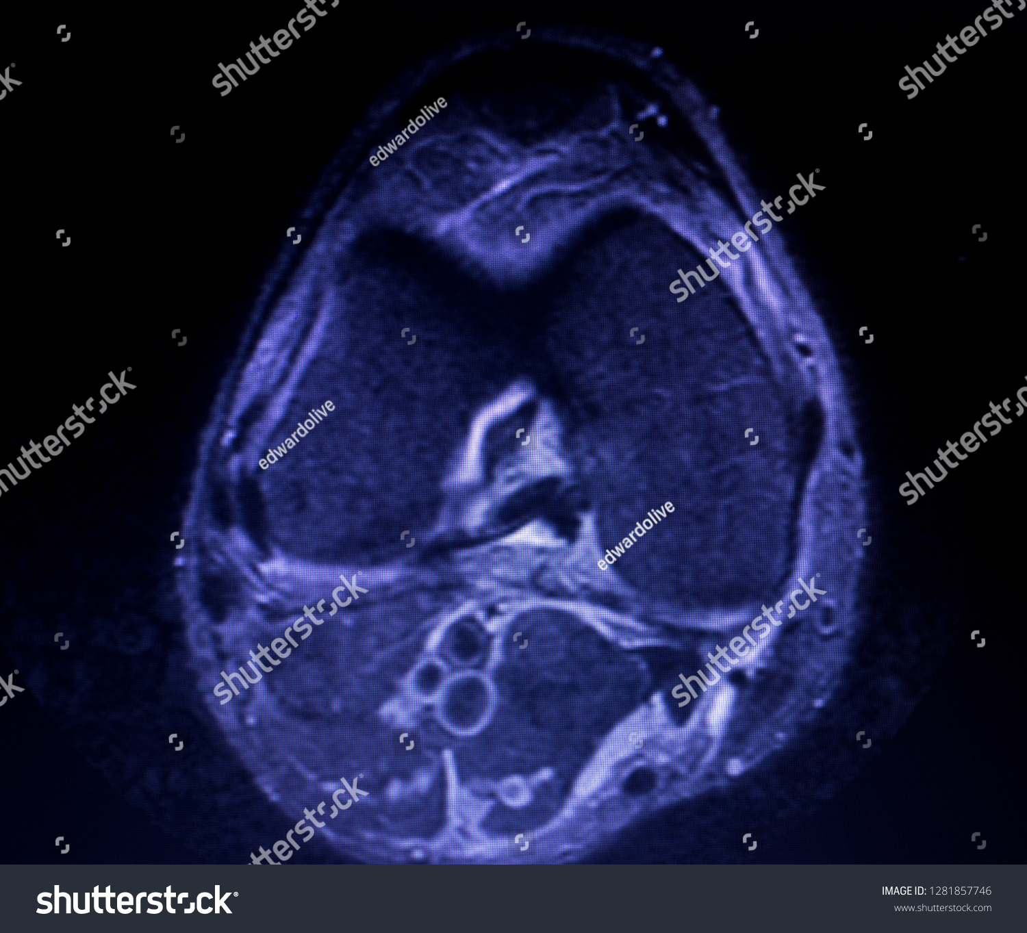 Magnetic Resonance Imaging Mri Knee Posterior Stock Photo 1281857746 ...