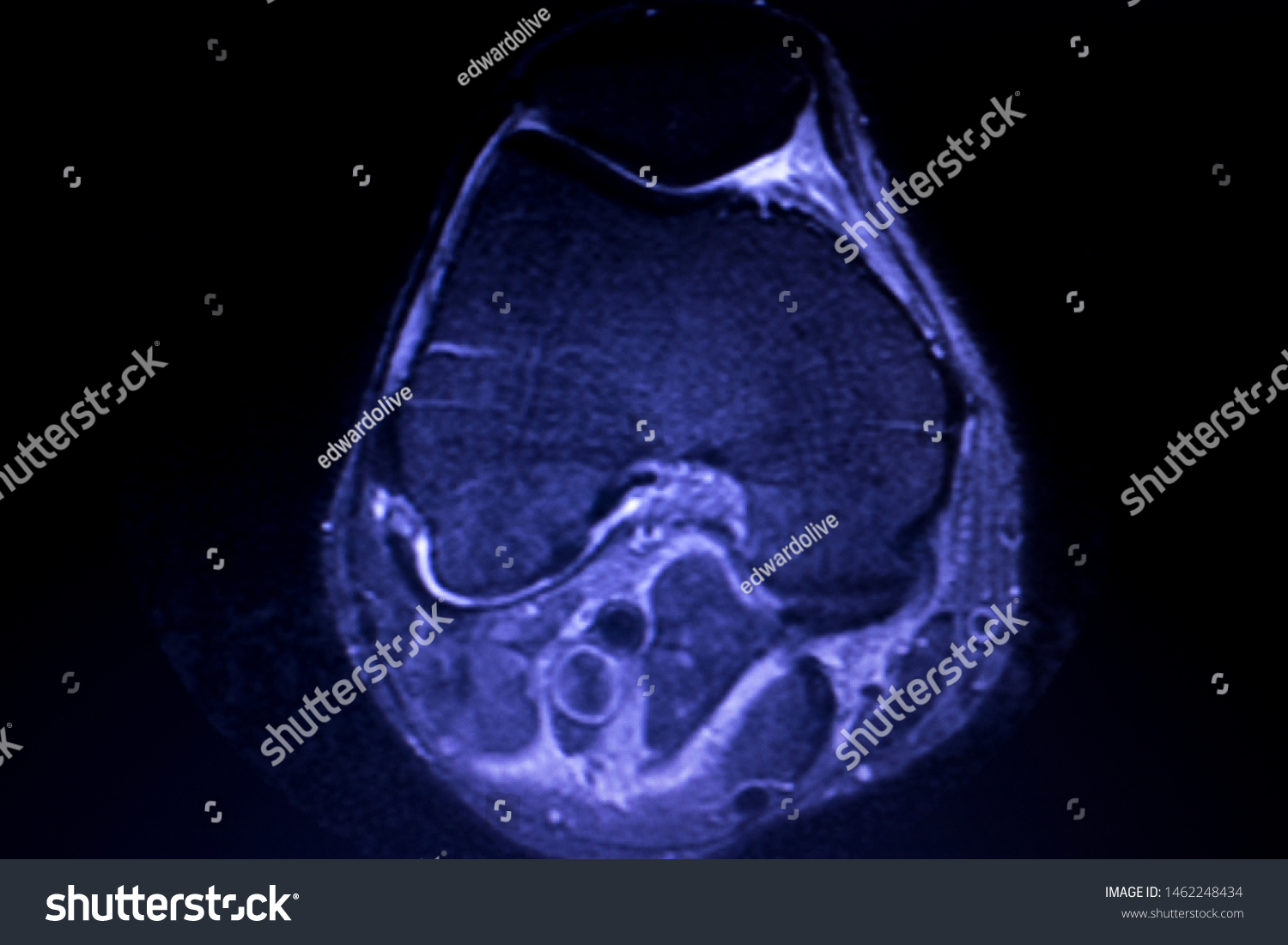 Magnetic Resonance Imaging Mri Knee Posterior Stock Photo (Edit Now ...