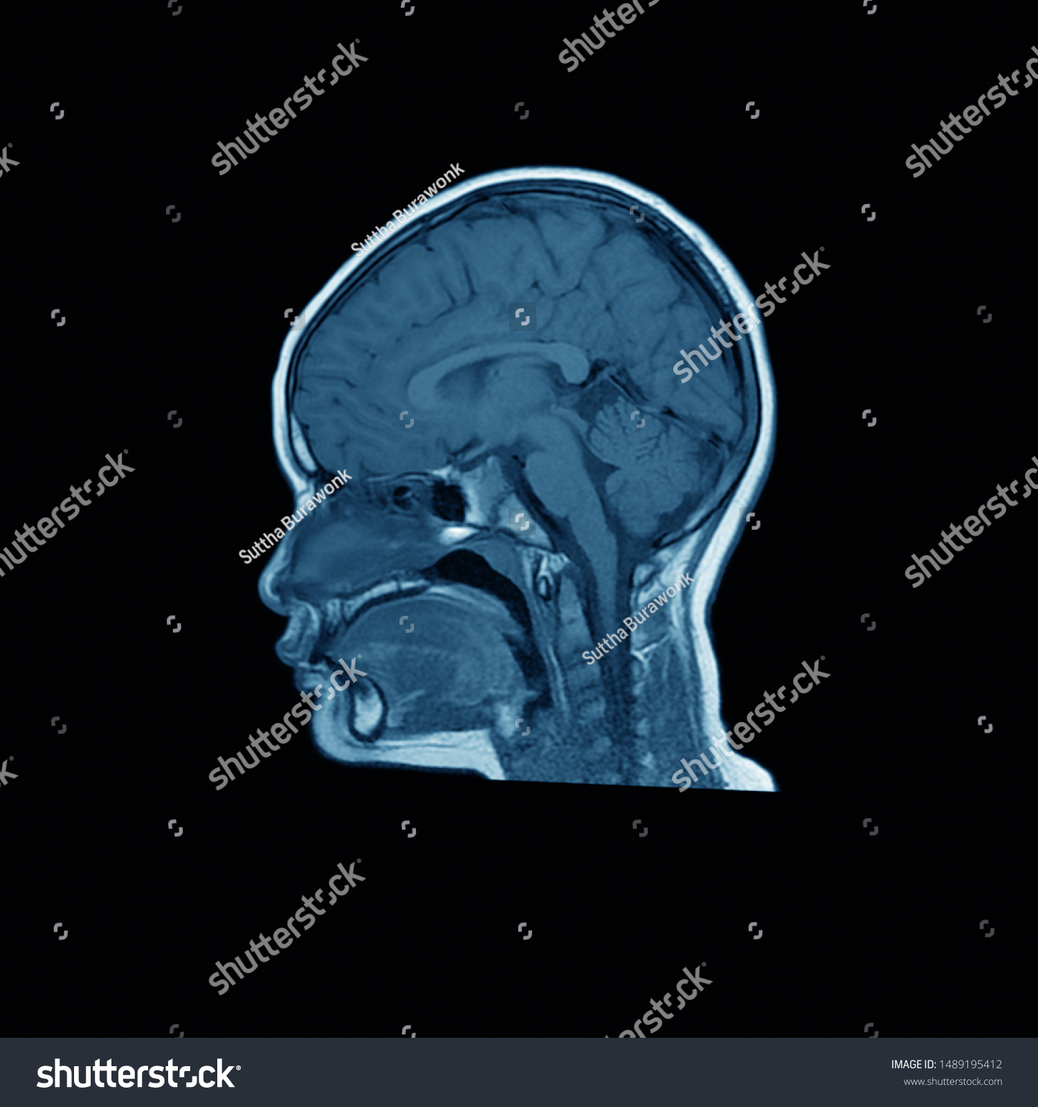 Magnetic Resonance Imaging Mri Brain Sagittal Stock Photo 1489195412 ...