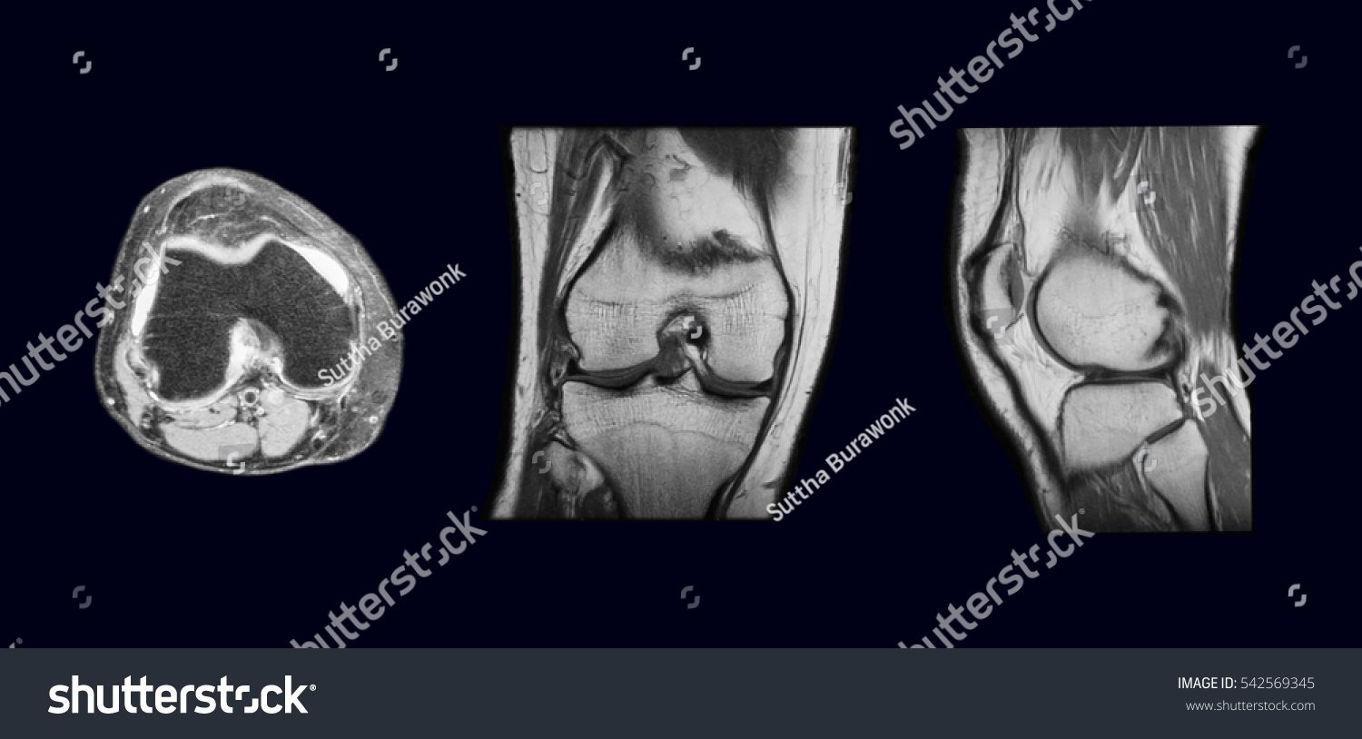 Magnetic Resonance Imaging Mri Right Knee Stock Photo (Edit Now) 542569345