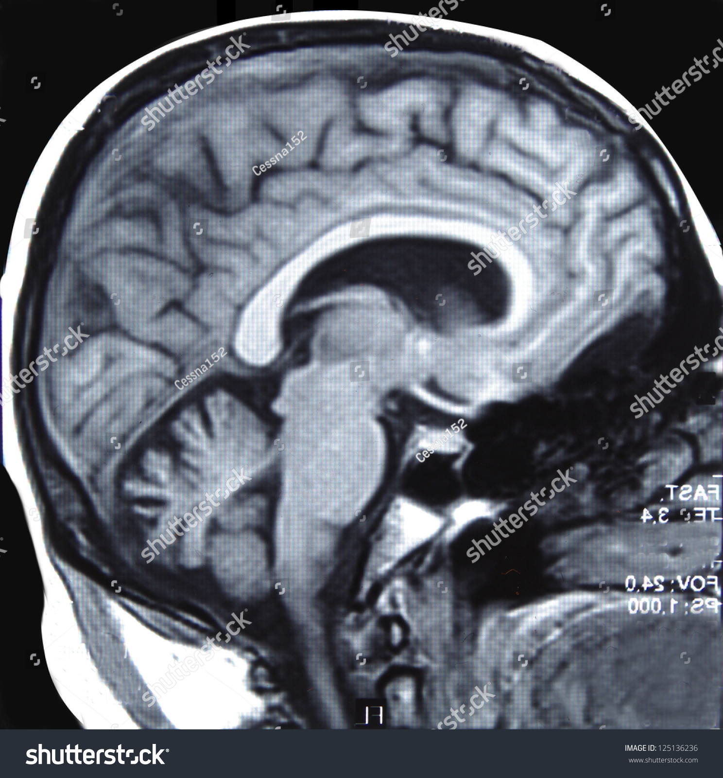 Magnetic Resonance Imaging ( Mri ) Of The Head And Brain Stock Photo ...