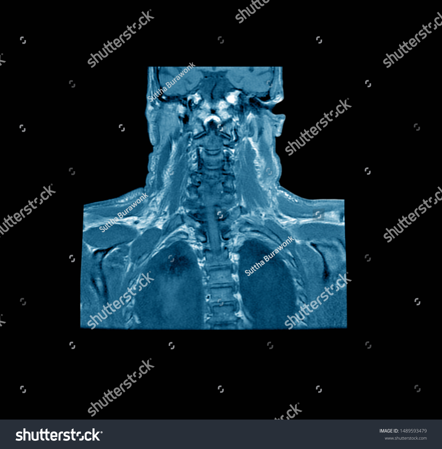 Magnetic Resonance Imaging Mri Scan Cervical Stock Photo Edit Now Magnetic Resonance Imaging Mri Scan Cervical Stock Photo Edit Now