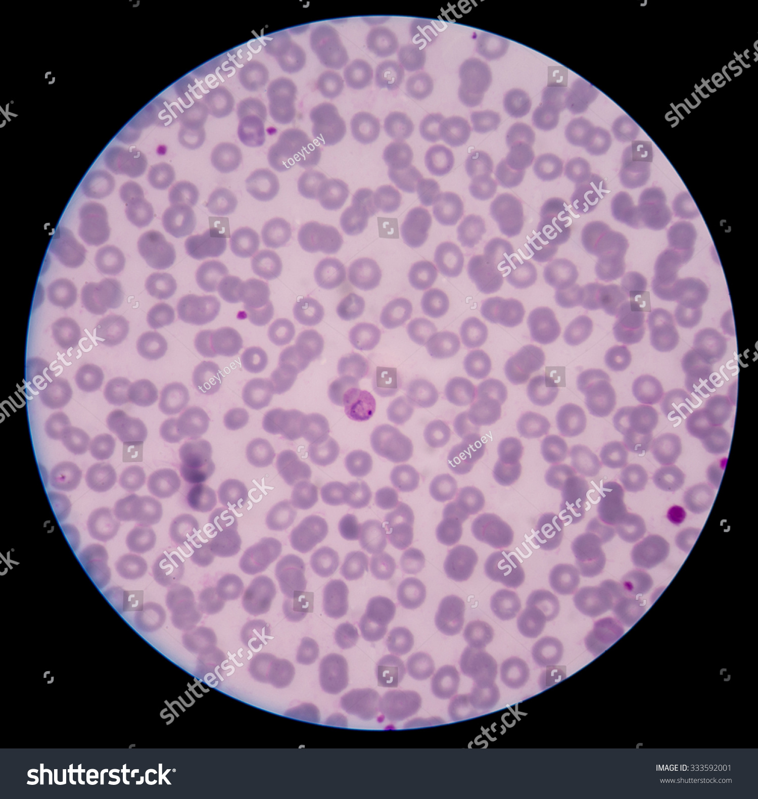 Malaria. Normal And Infected Red Blood Cells. Malaria Is A Disease ...