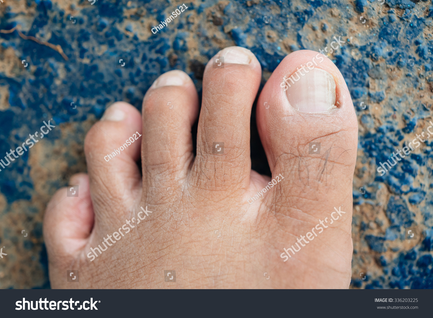 Male Foot And Toes On Steel Floor Background Stock Photo 336203225 ...