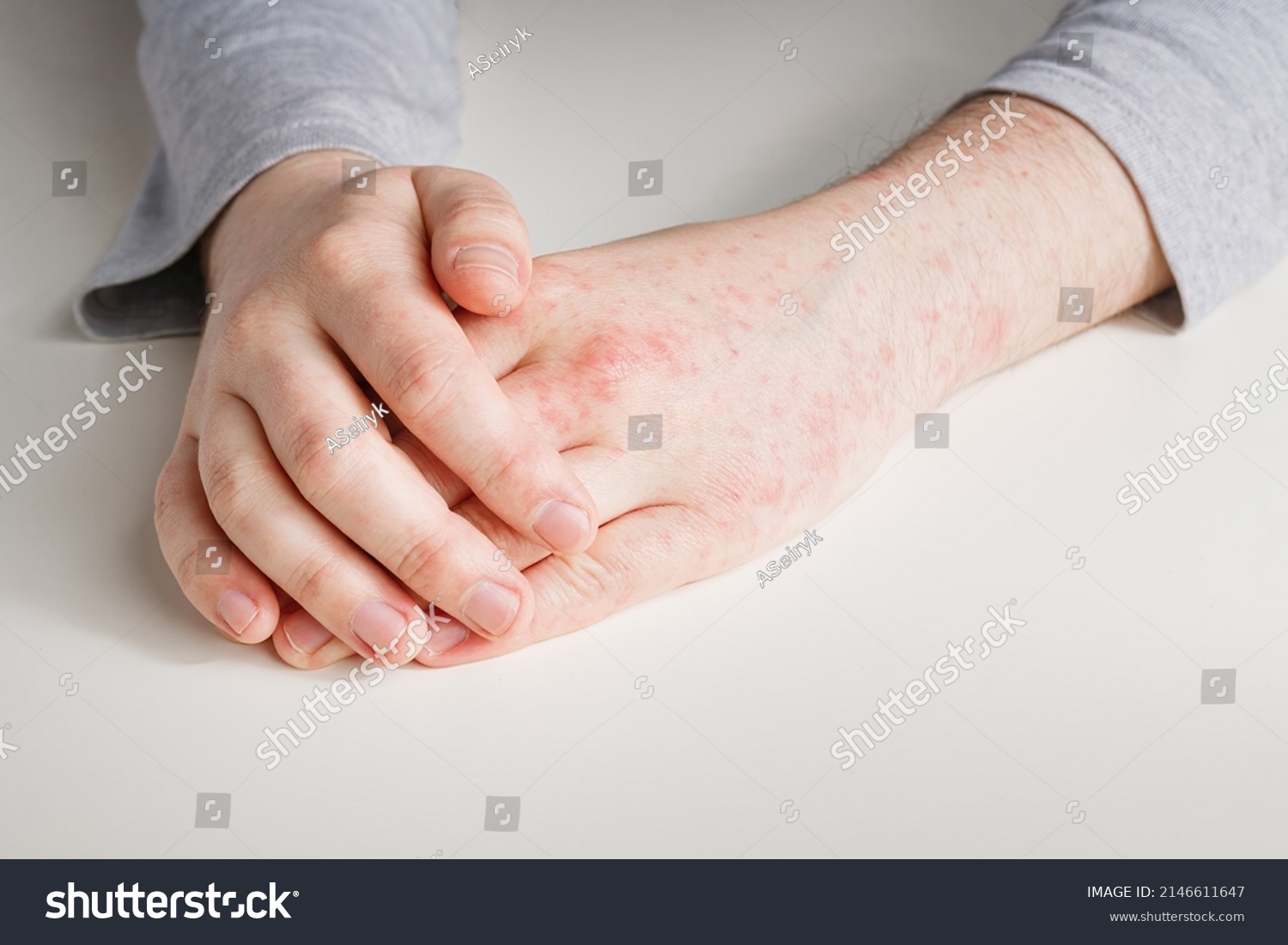 male-hands-red-spots-on-skin-stock-photo-2146611647-shutterstock