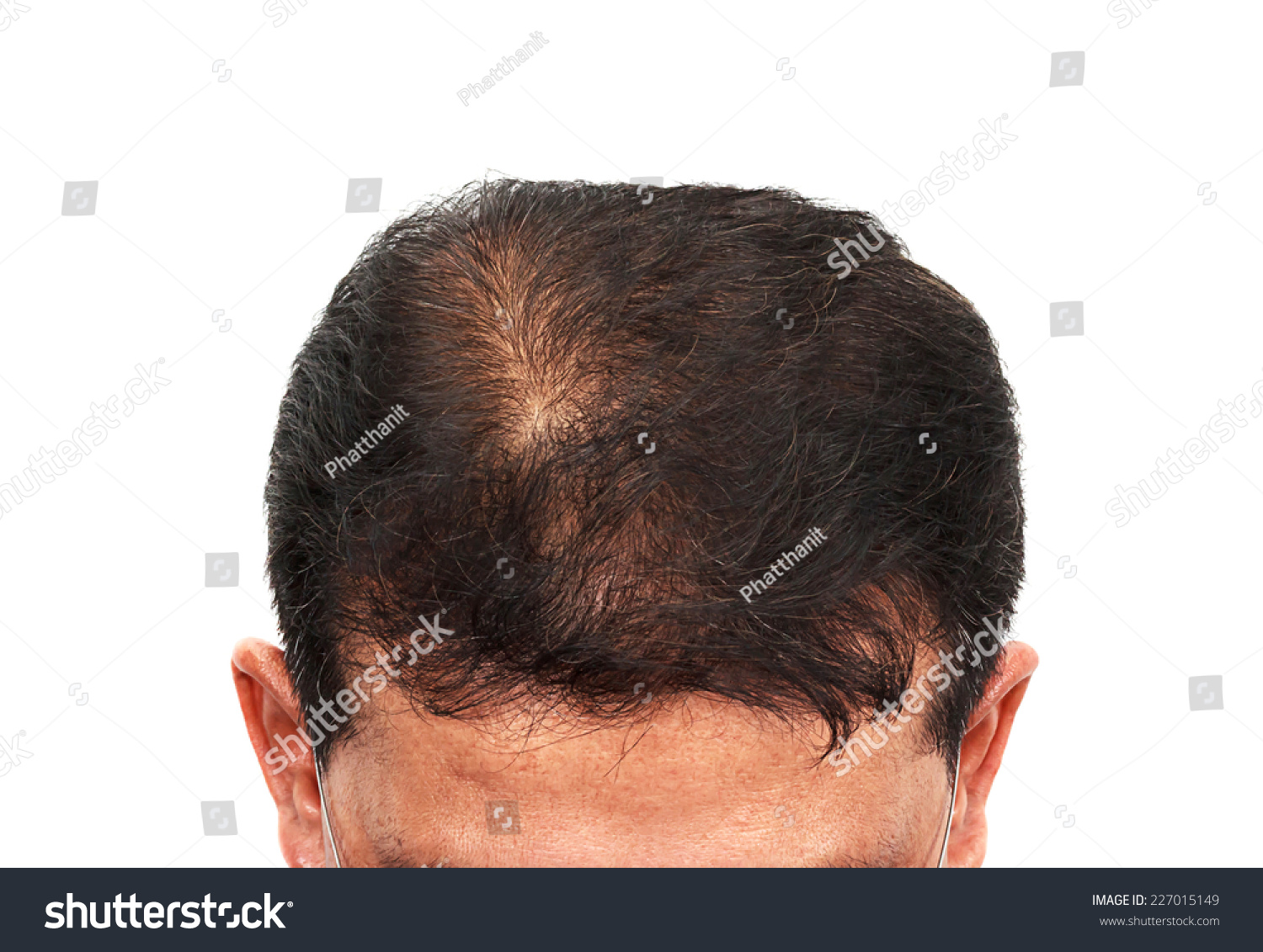 Male Head Hair Loss Symptoms Front Stock Photo Edit Now 227015149