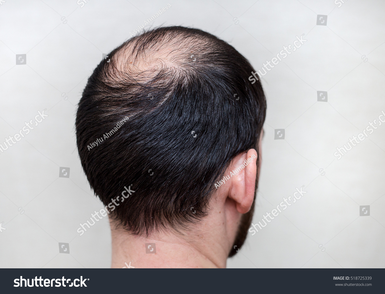 Male Head Thinning Hair Alopecia Stock Photo Edit Now 518725339